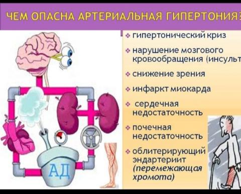 ЭССЕНЦИАЛЬНАЯ ГИПЕРТЕНЗИЯ (ПЕРВИЧНАЯ)