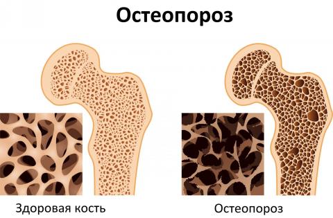Береги кости смолоду