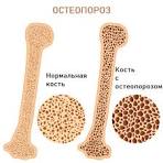 Профилактика остеопороза